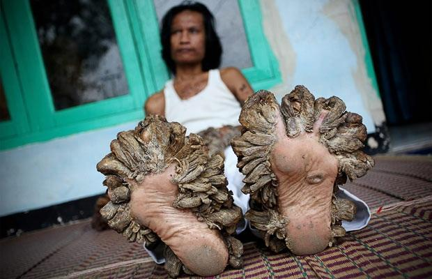 Dédé Koswara et la plante de ses pieds