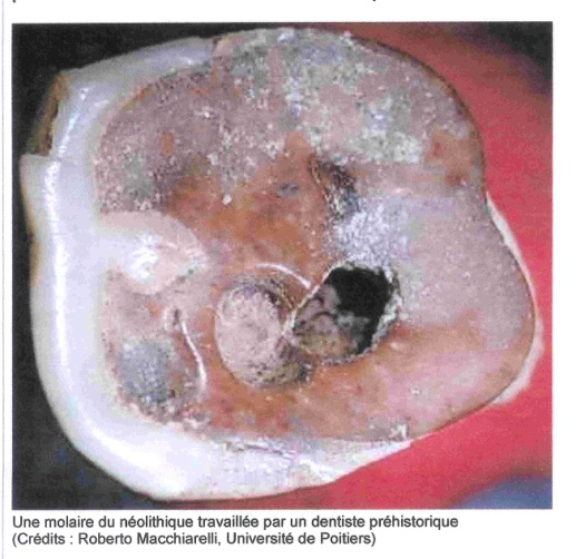 Une molaire du néolithique travaillée par un dentiste préhistorique