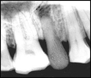Confirmation radiologique de l’infection au niveau de la dent artificielle